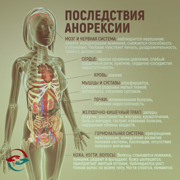 Последствия анорексии инфографика