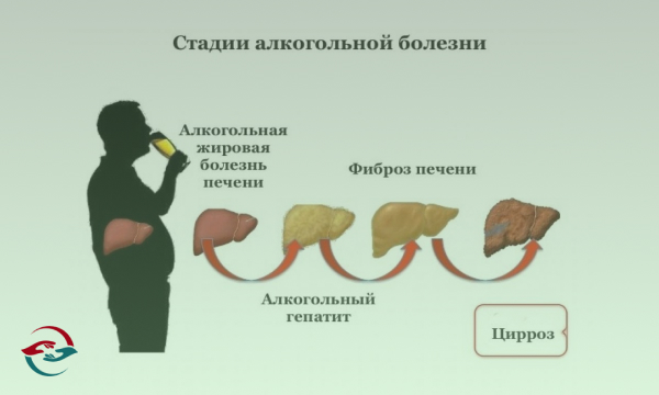 Стадии алкогольной болезни схема